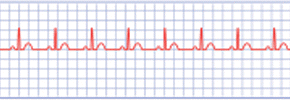 Cosa è l'Arresto Cardiaco?