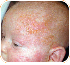 Psoriasis topical steroids