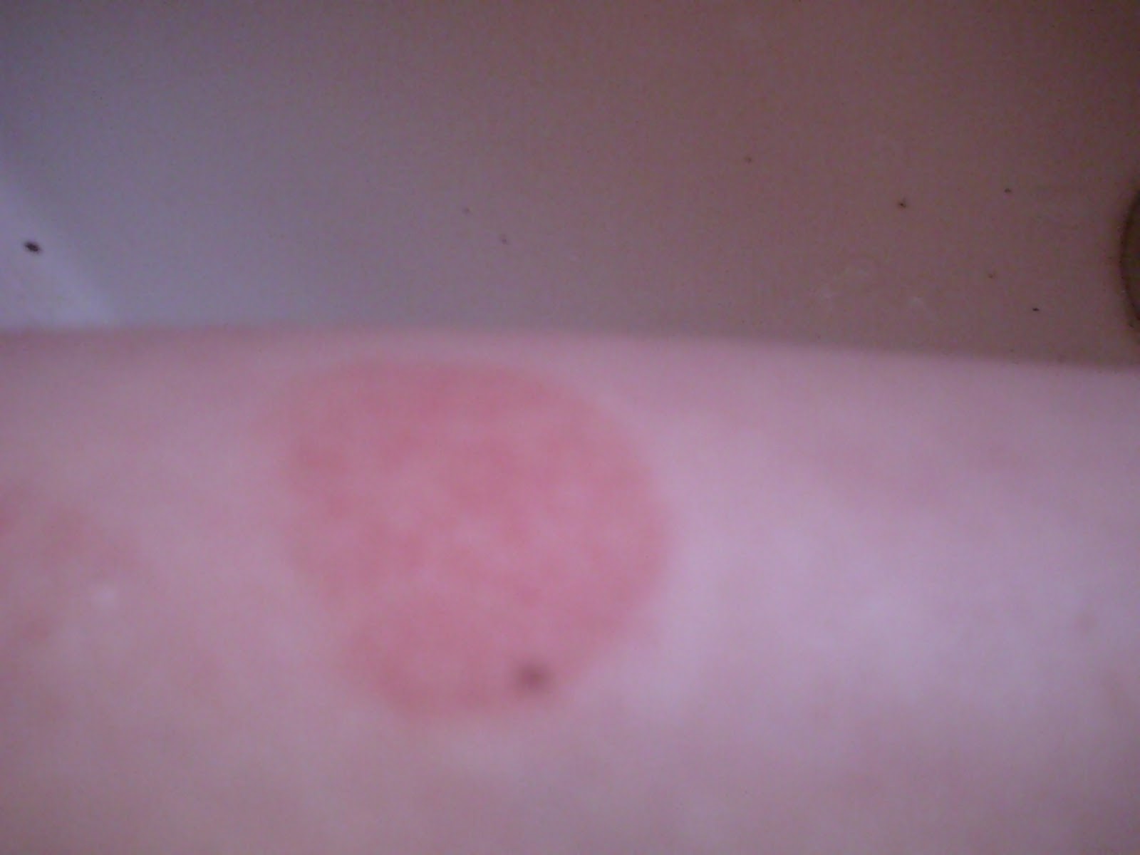 Diary of Lyme Girl Congenital Lyme Reoccurring Bulls Eye Rash