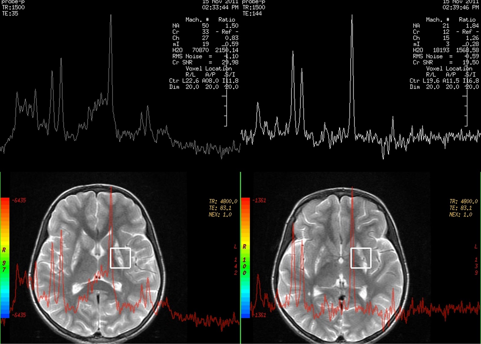 Dr Balaji Anvekar FRCR Leigh's MR Spectroscopy