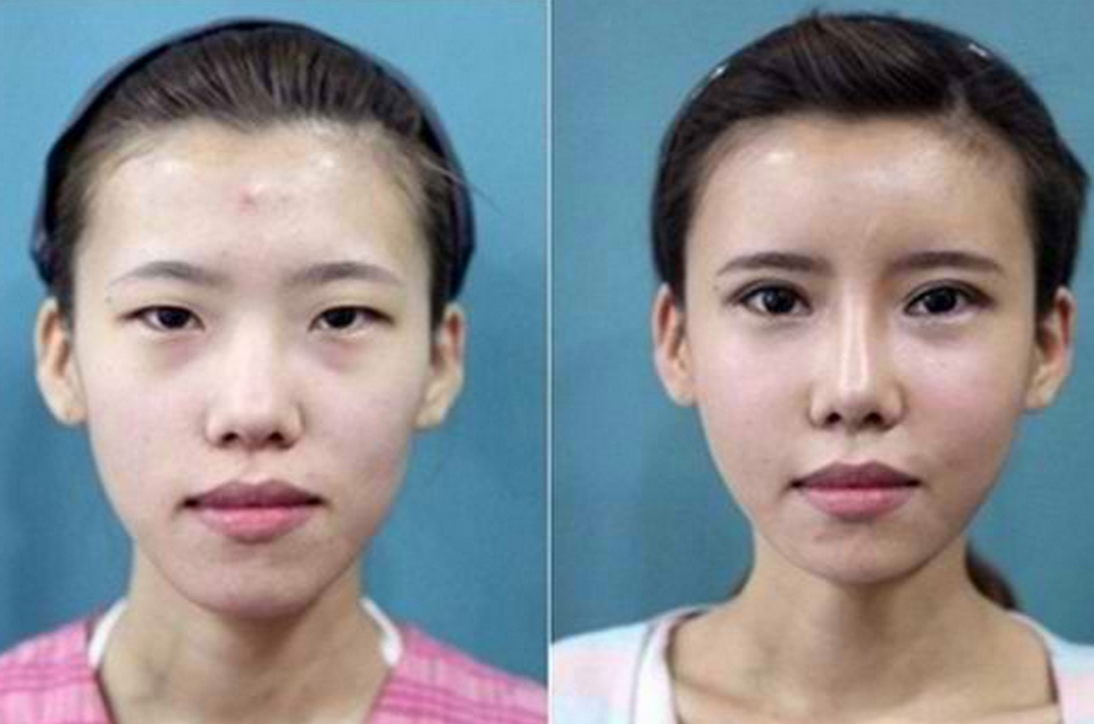 20 Almost Unrecognizable Plastic Surgery Before & Afters.