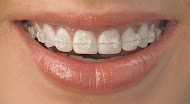 Aparelho Ortodontico