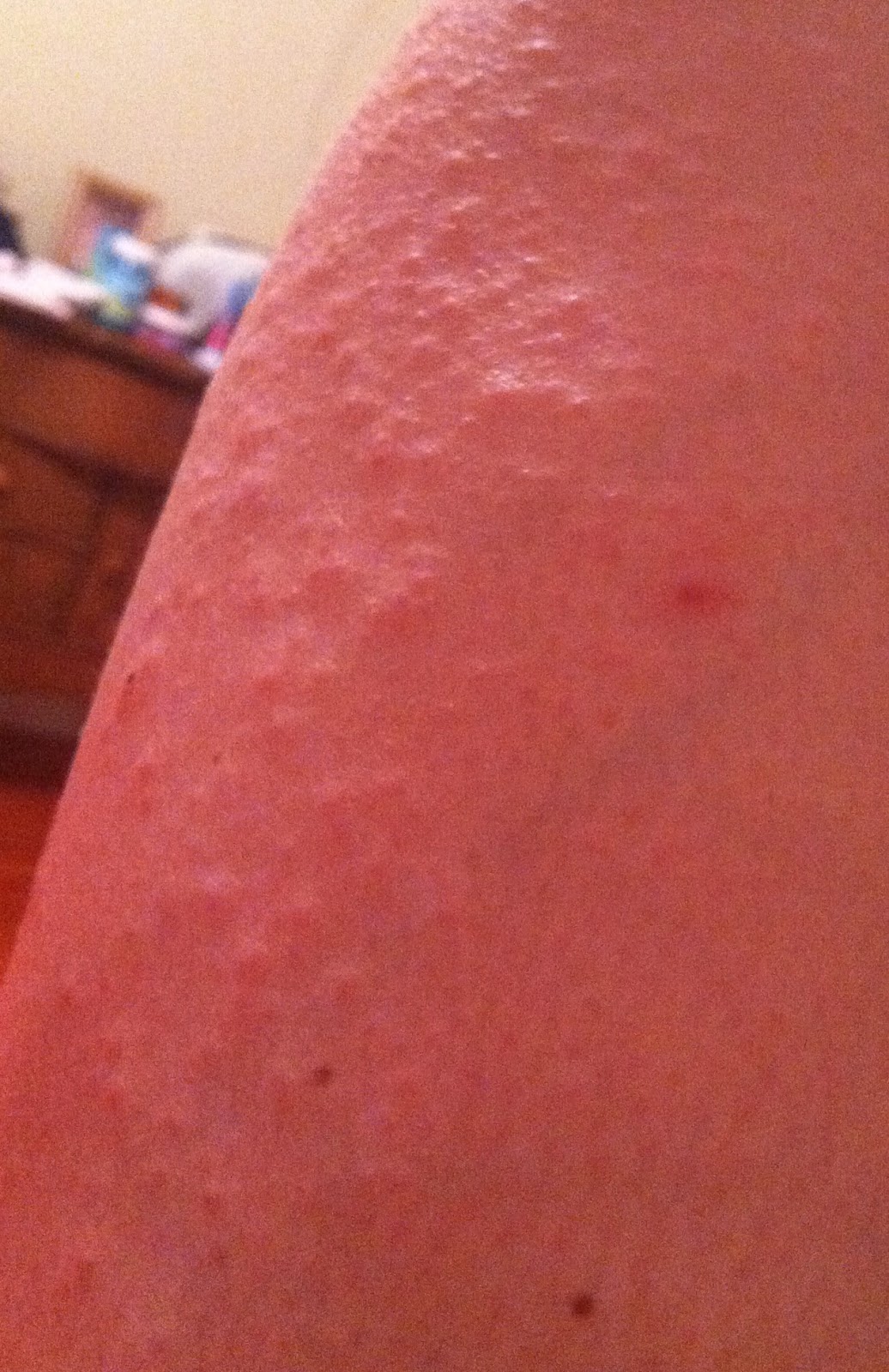 Sickness Is Fascinating Scabies I