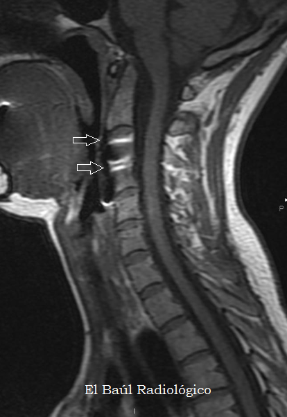 Artrodesis+cervical+3.png