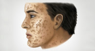 Picture of Ichthyosis Vulgaris