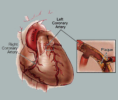 What Is Coronary Heart Disease?