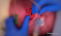 Nasal vs. Oral intubation in general anesthesia for dental treatment Nasal Oral intubation general anesthesia dental treatment