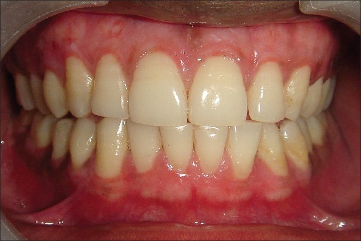 Zirkonyum Diş Nedir? Zirkon, Empress ve porselen diş kaplama fiyatı