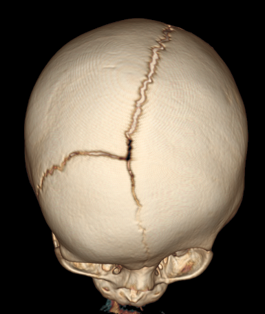 Alice in Cranioland: Review of Craniosynostosis and Our Story