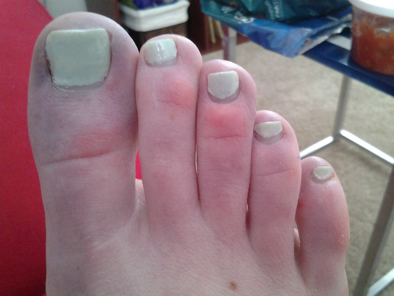 Lyme of my Life Toes