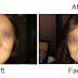 Face Lift Surgery in India