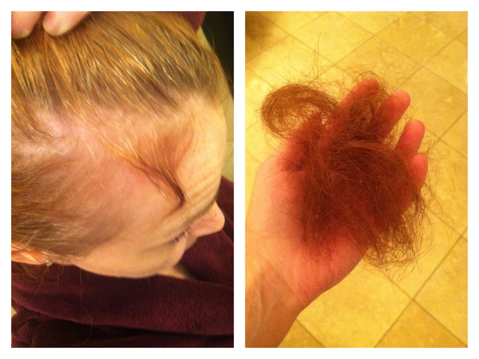 My UC Story Healing Scars 6 Weeks Post Reversal Surgery