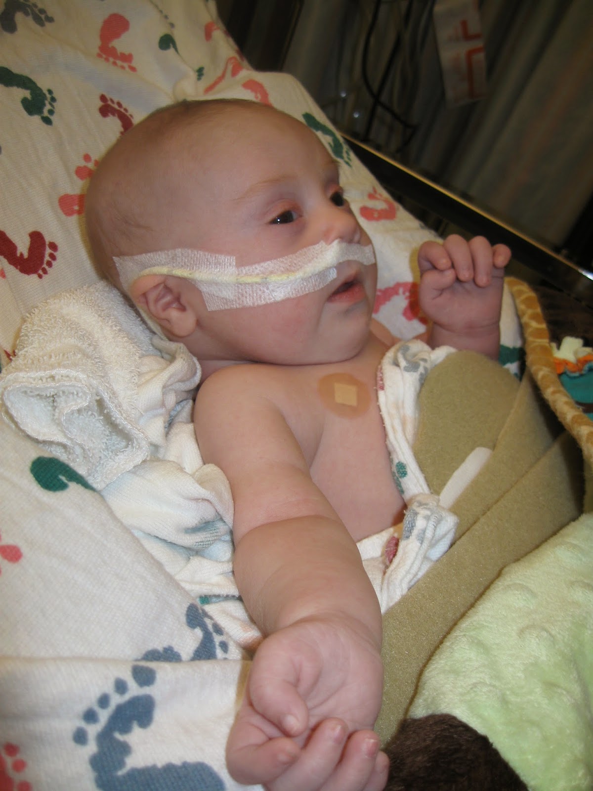 Jacob with his NG tube due to failure to thrive and reflux