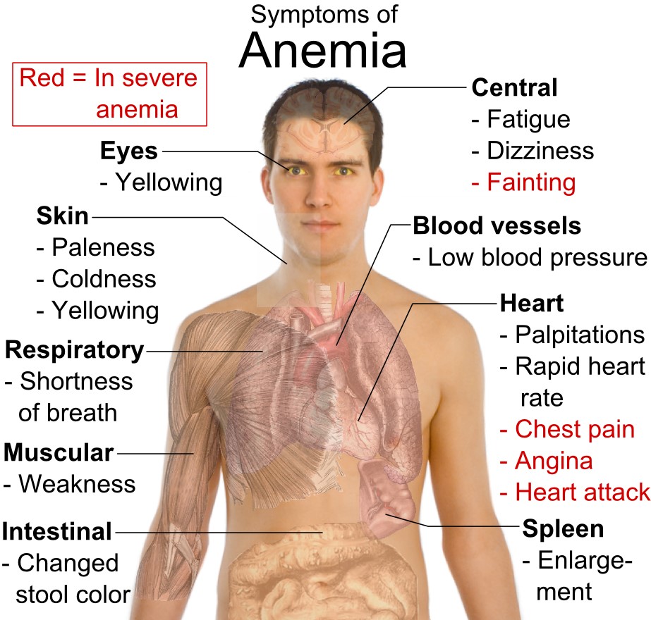 Dr Ajays Homeopathy Homeopathy remedies for Anemia