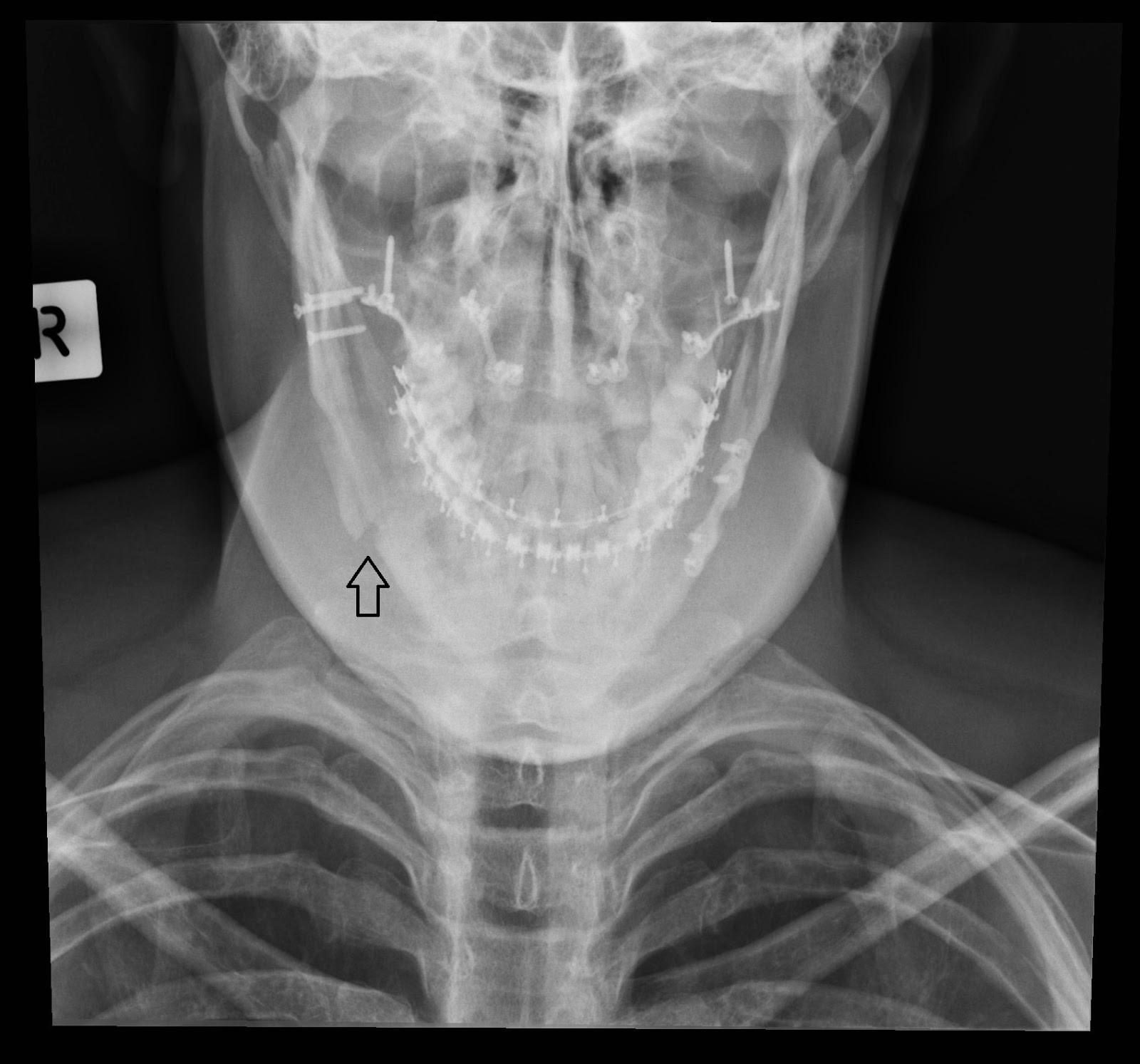 Double jaw surgery with a bit of hip thrown in! Day 49 Seven Weeks On....