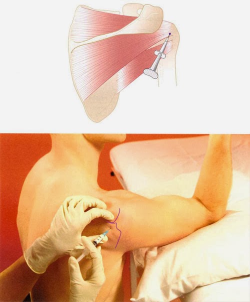 Enthesitis points body map image