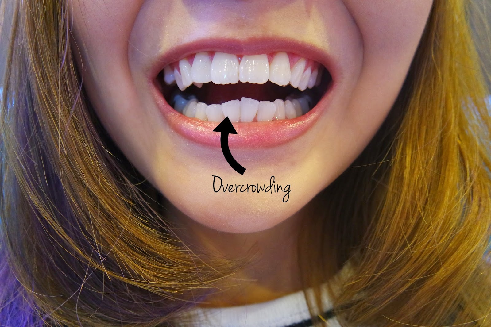 EUNICE ANNABEL My Invisalign Journey at i.Dentalsg (Invisalign Review)