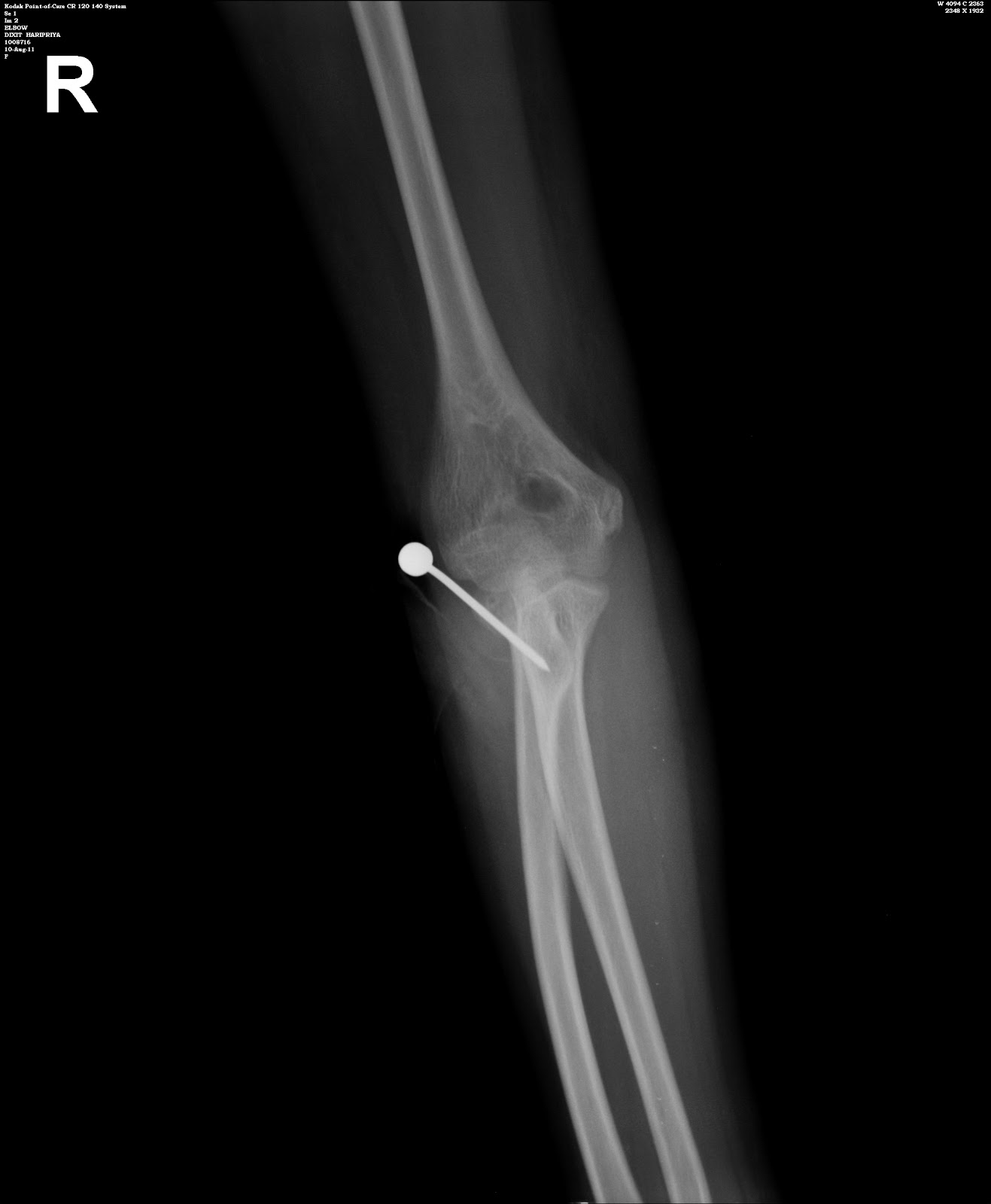 cpt code for orif radial head fracture cpt code for orif radial head fracture