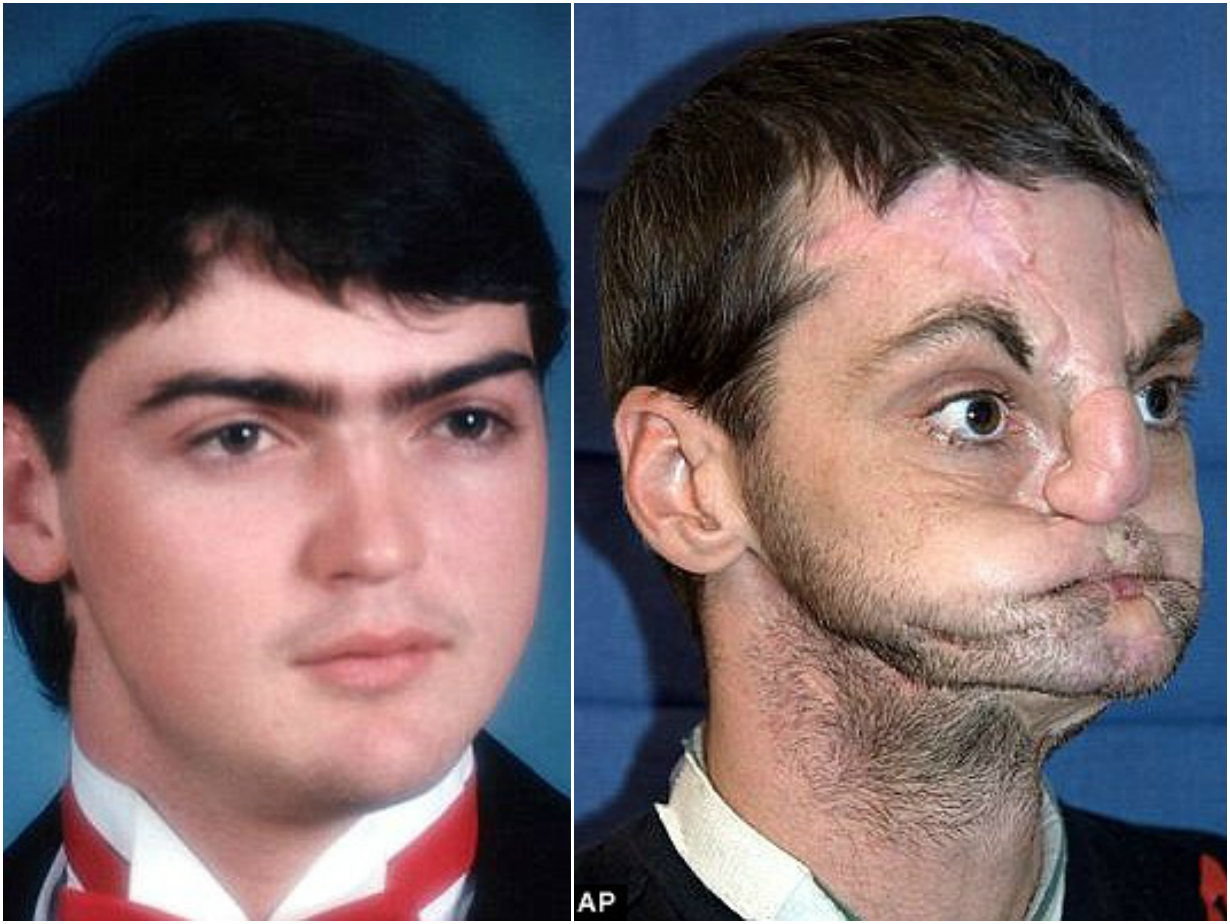 Face Blown Off By Shotgun 2 Kamify Blog Man Who Disfigured Himself After Accidentally Blowing Off