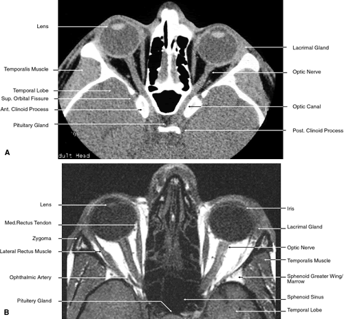 axial ct anatomy of orbit