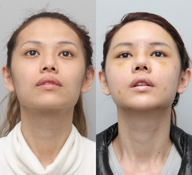 QiuQiu Great fantastic results (Nose Job / FatGrafting Part 3)