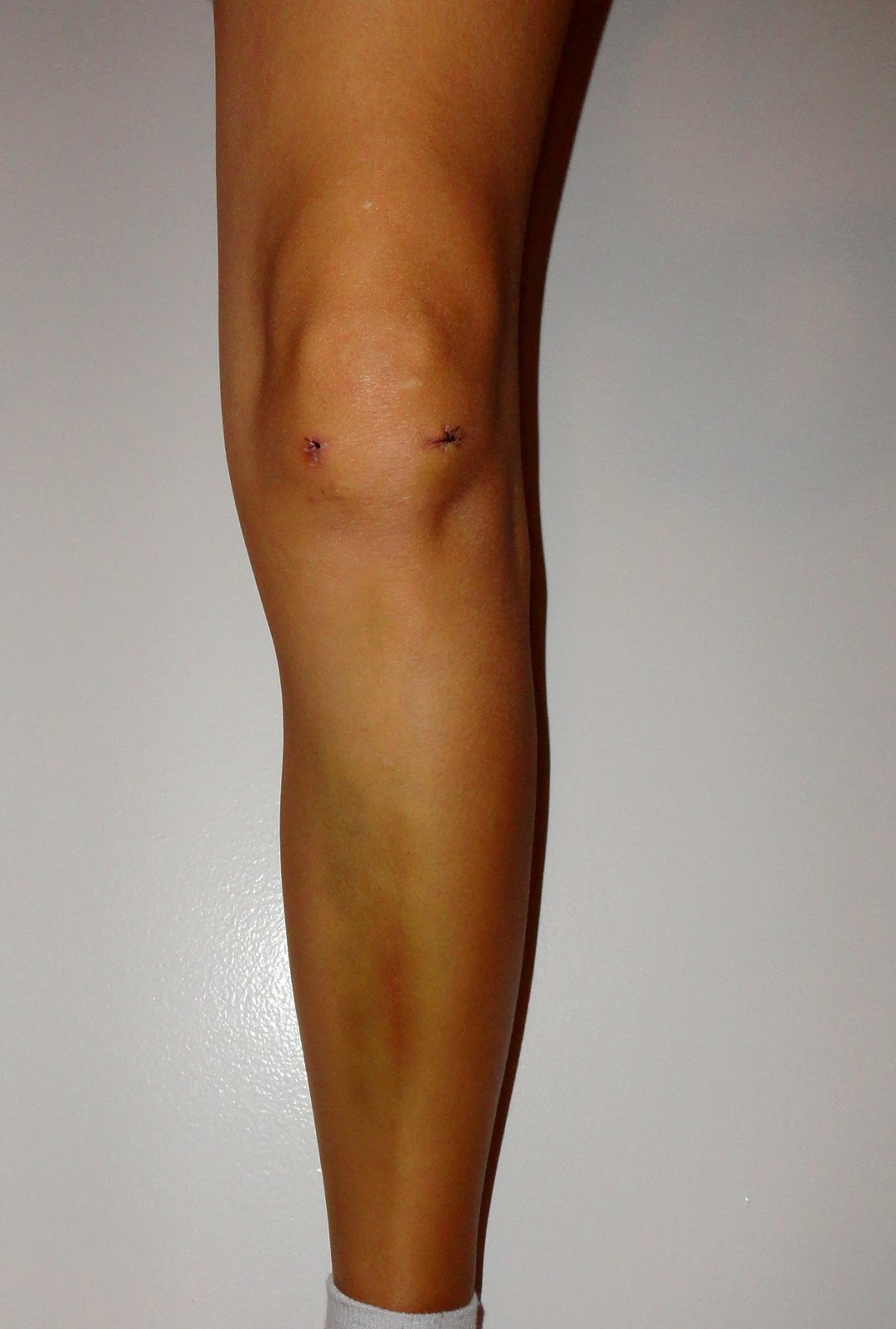 Mellissa Rose Two Weeks After Knee Surgery