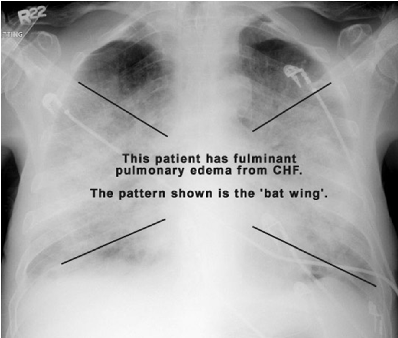 Chest radiograph of different conditions Geoffrey E. Reed life
