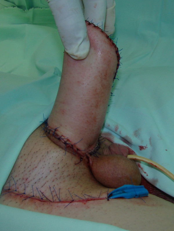Lower half surgery only for transvestite married