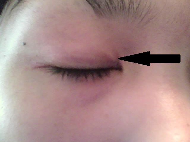 Sore Dry Patch Eyelid