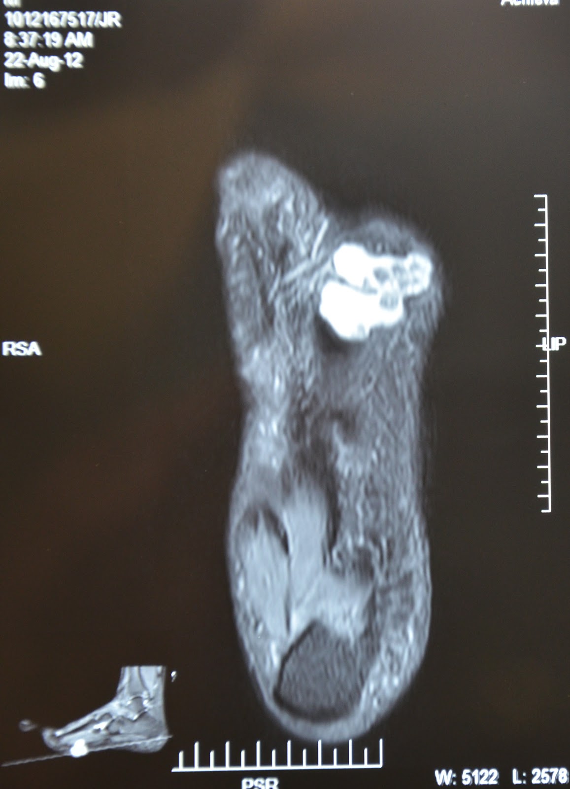 RARE SOFT TISSUE TUMOR FOOT PARAOID HYDRADENOMA EXCISION AND