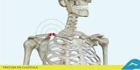 Fisioterapia - Recuperação de fraturas