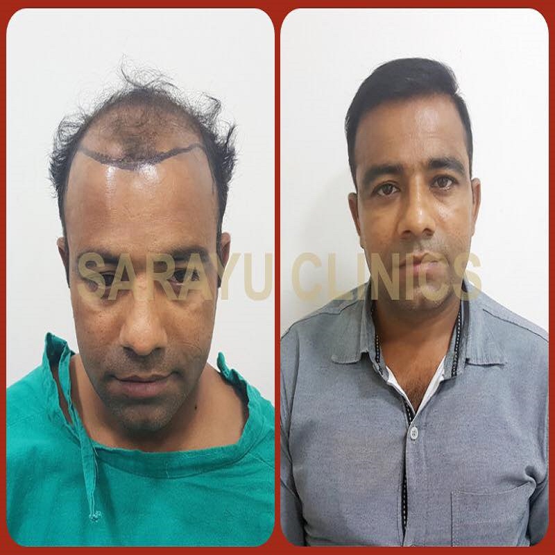 Hair Transplant In India