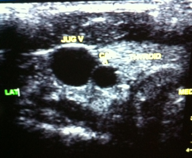 SonoPro: Upper Extremely Venous Ultrasound Scan Protocol