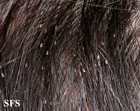 Why Is There White Stuff In My Hair