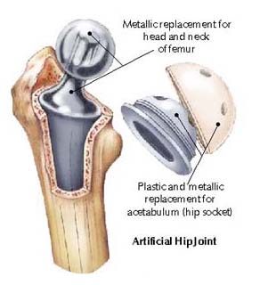 Artificial Hip Joint