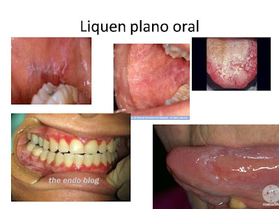 Liquen plano oral Liquen plano oral