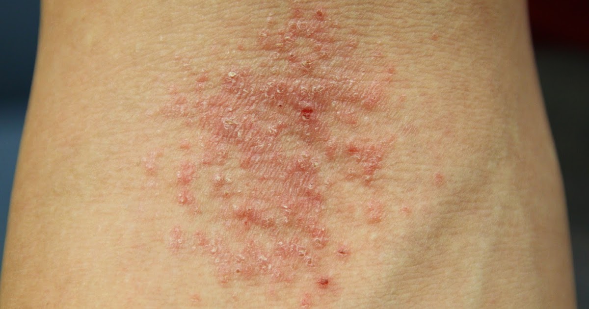 Reshape Life! Eczema The Itch That Keeps On Itching