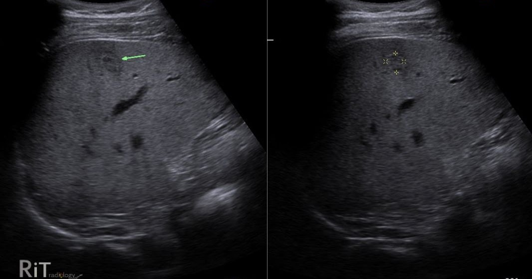 RiT radiology Atypical Hepatic Hemangioma Echoic Border RiT radiology Atypical Hepatic Hemangioma Echoic Border