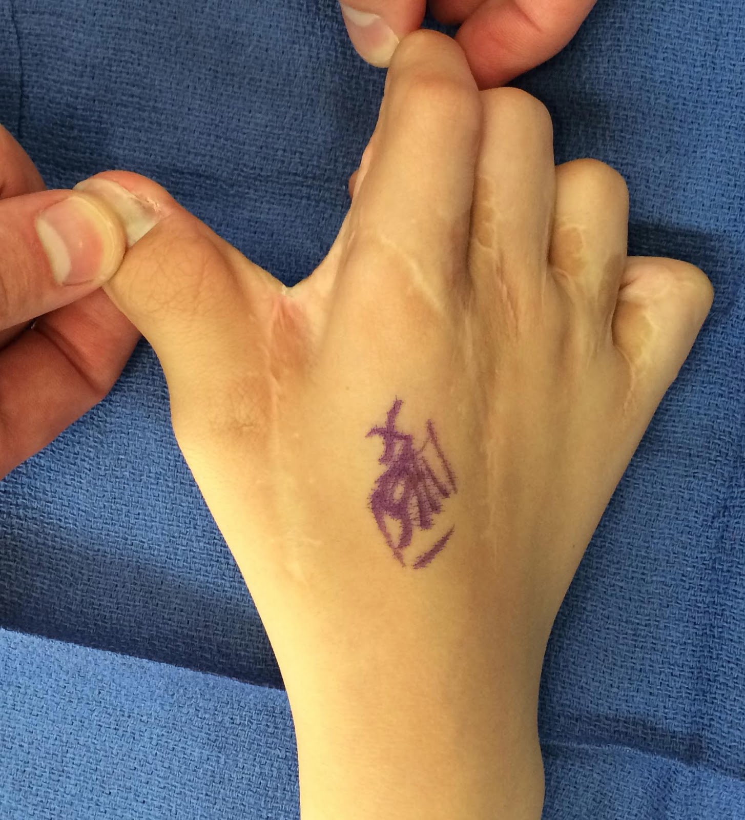 Syndactyly and Challenges Congenital Hand and Arm Differences Washington University