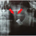 Exodontia do Siso + Comunicação buco sinusal