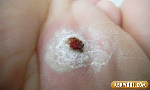 corn removal pictures