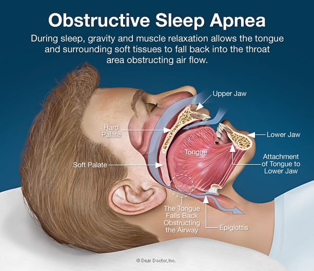 Breathing Treatment for Sleep Apnea May Help Protect Against Heart Failure