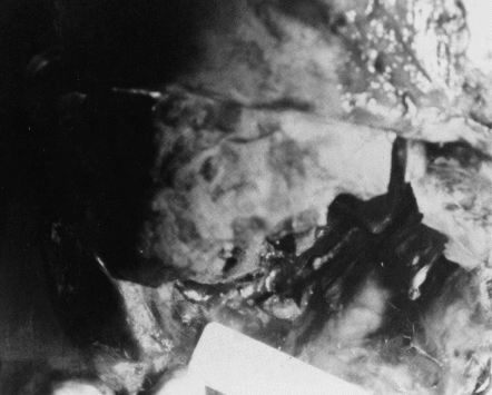 F8-JFK-Autopsy-Photo-Pat-Speer.gif