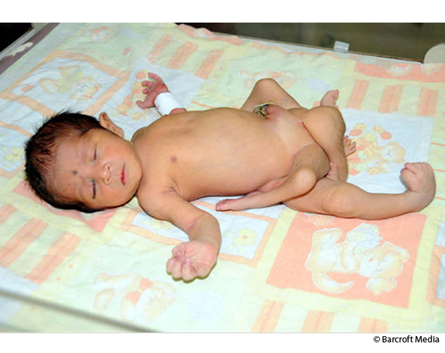 Bayi Terlahir dengan Enam Kaki