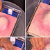 Best Way To Attack A Pimple Without Damaging Your Skin