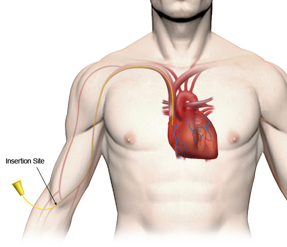 picc line chemo central inserted insertion peripherally catheters surgery lines lungs site definition through representation accurate muscle intervention
