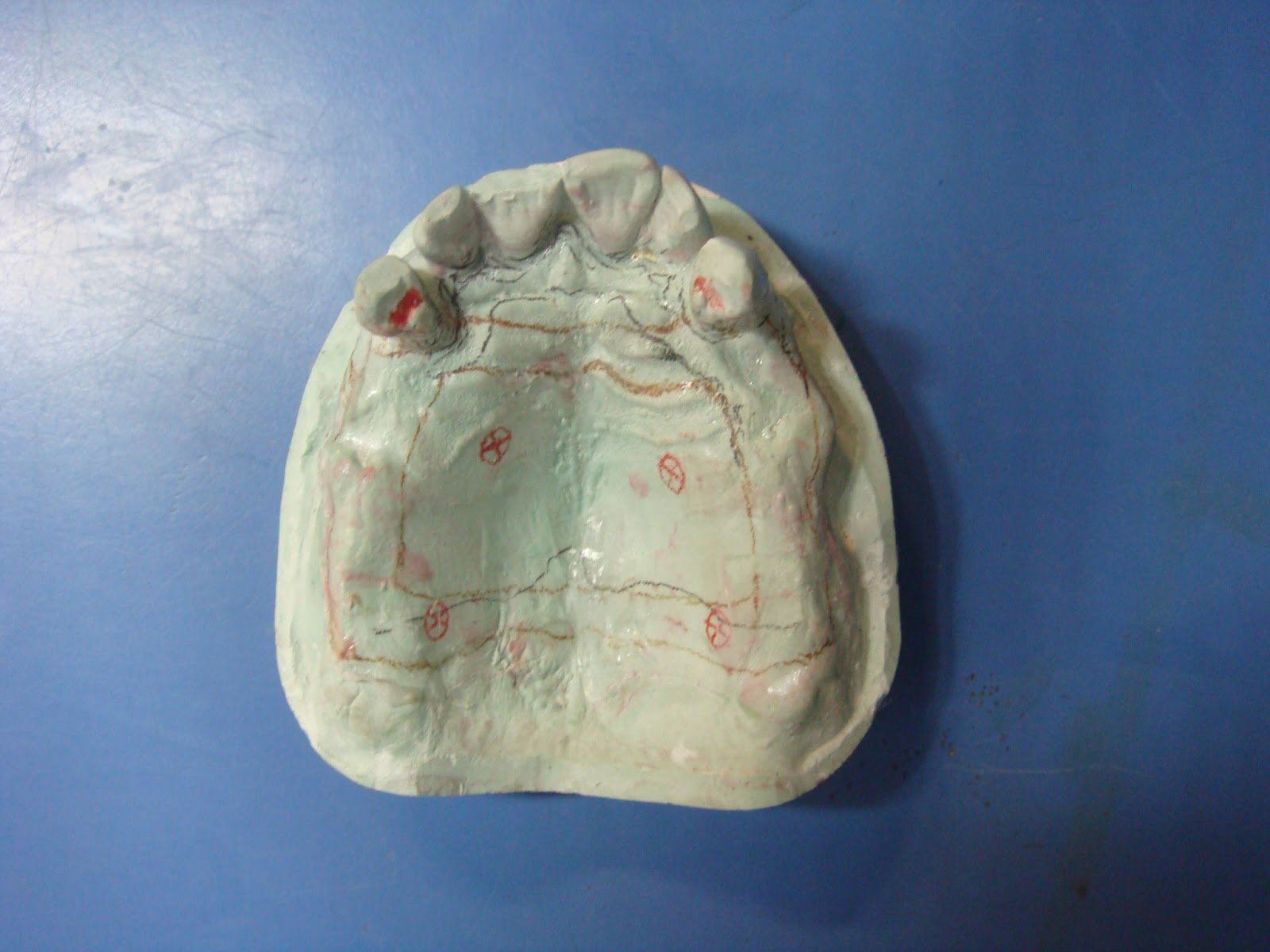 Step by step Guide for Understanding the Prosthodontics April 2013