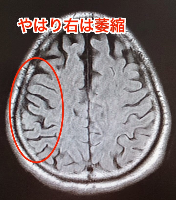 皮質基底核変性症(CBD)の頭部MRI
