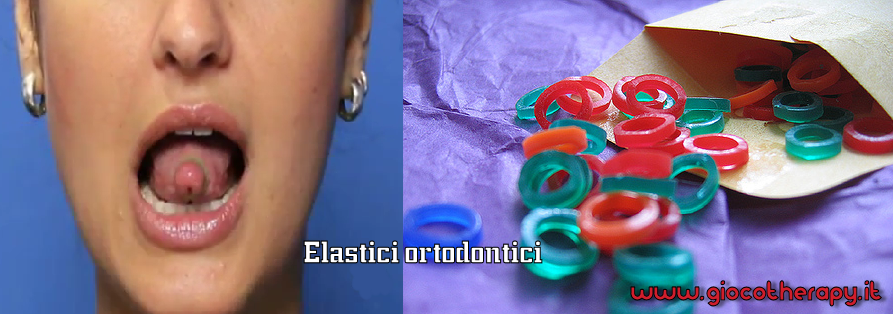 Utilizzo elastici ortodontici