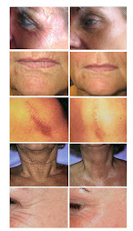 Resultat av Behandling med Derma-Laser